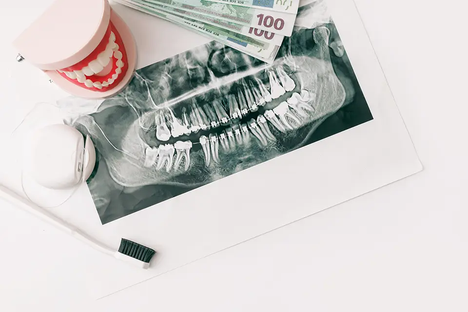 Cost of Root Canal and Crown