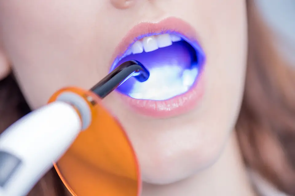 Opalescence Whitening