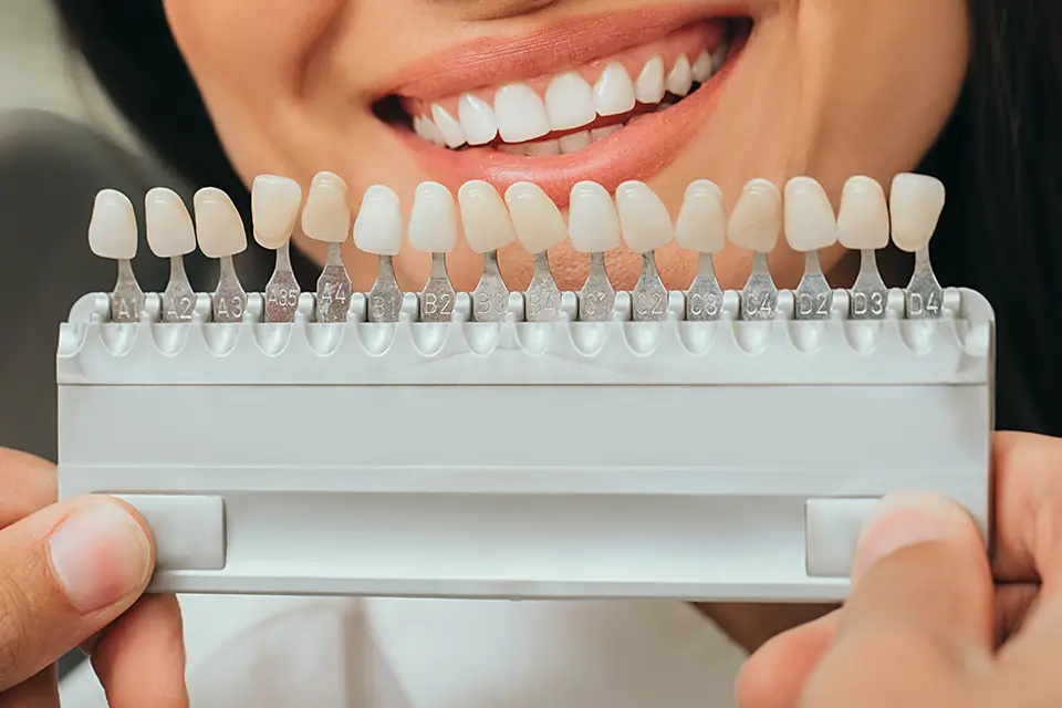 Permanent Porcelain Veneers Cost