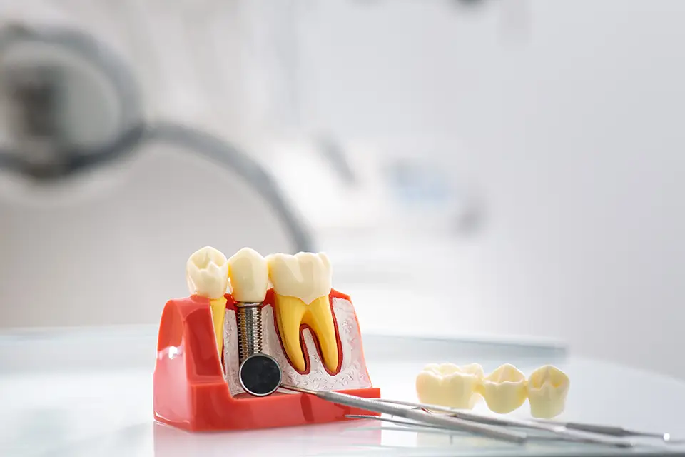 Bone Graft Dental Cost