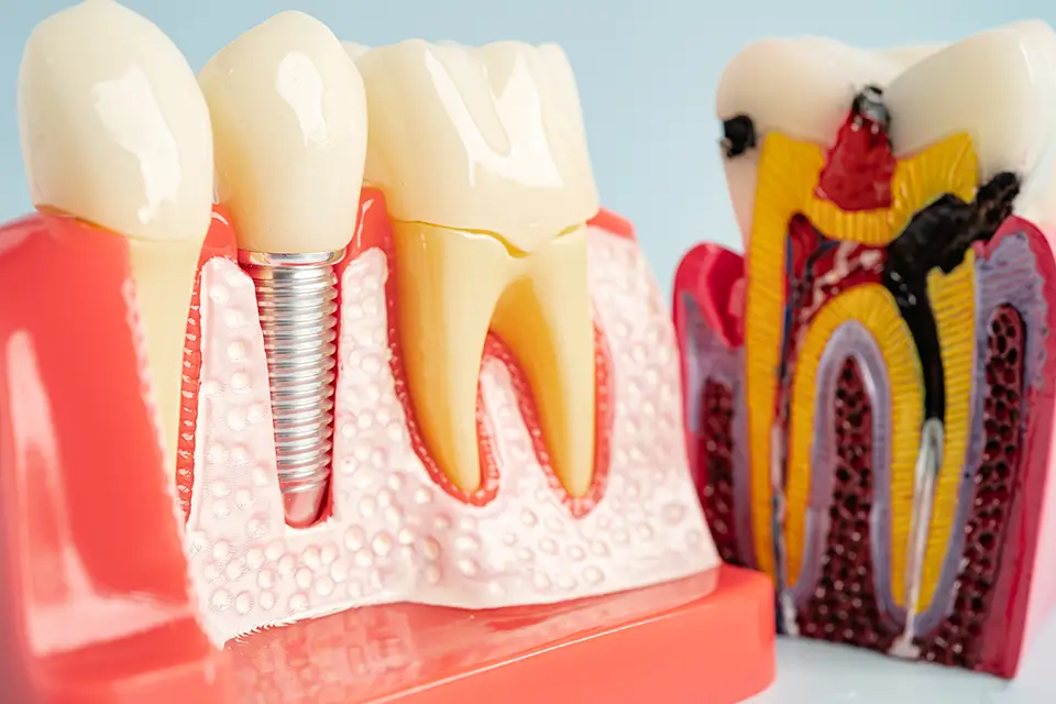 Can You Get Dental Implants If You Have Gum Disease?