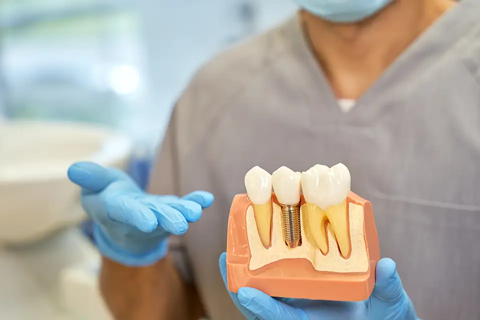 Dental Crowns vs. Implants: Which Option is Right for You?
