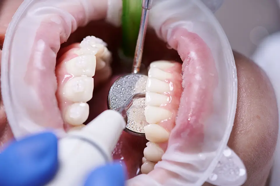 What Is a Dental Bone Graft, and Why Does Your Dentist Recommend It?