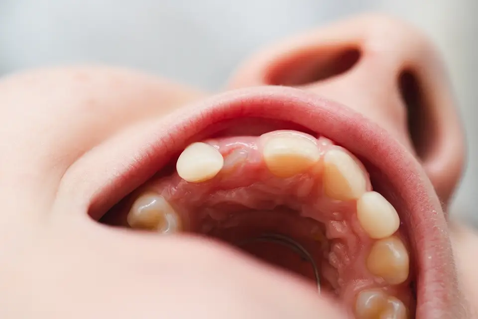 How Missing Teeth Can Change Your Facial Appearance