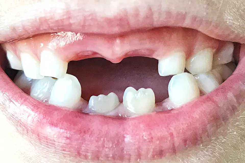 Can Missing Teeth Lead to Health Issues?