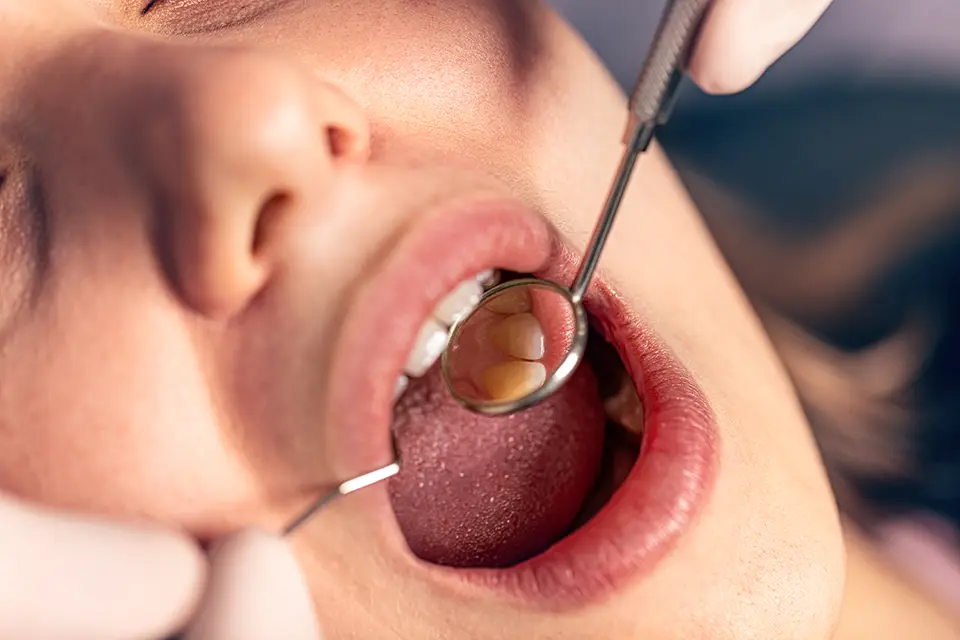Can Cavities Form Side Your Teeth?