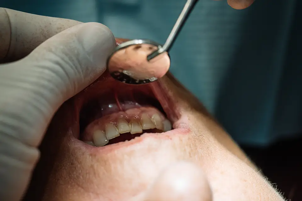 What Causes Gum Recession?