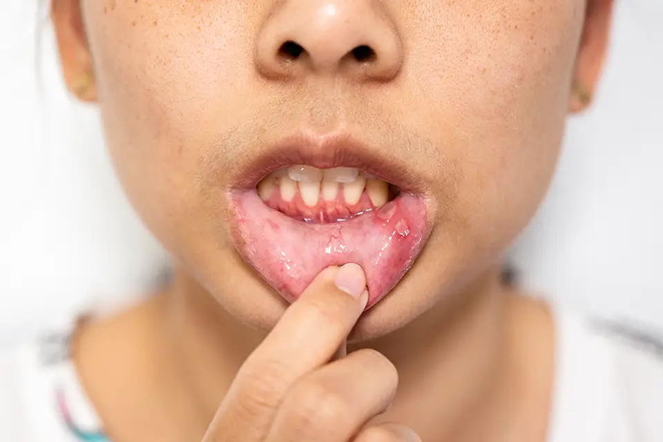 Home Remedies for Mouth Sores – and When to See a Dentist