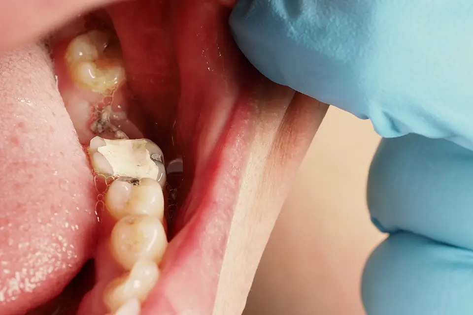 7 Effective Ways to Treat Tooth Erosion