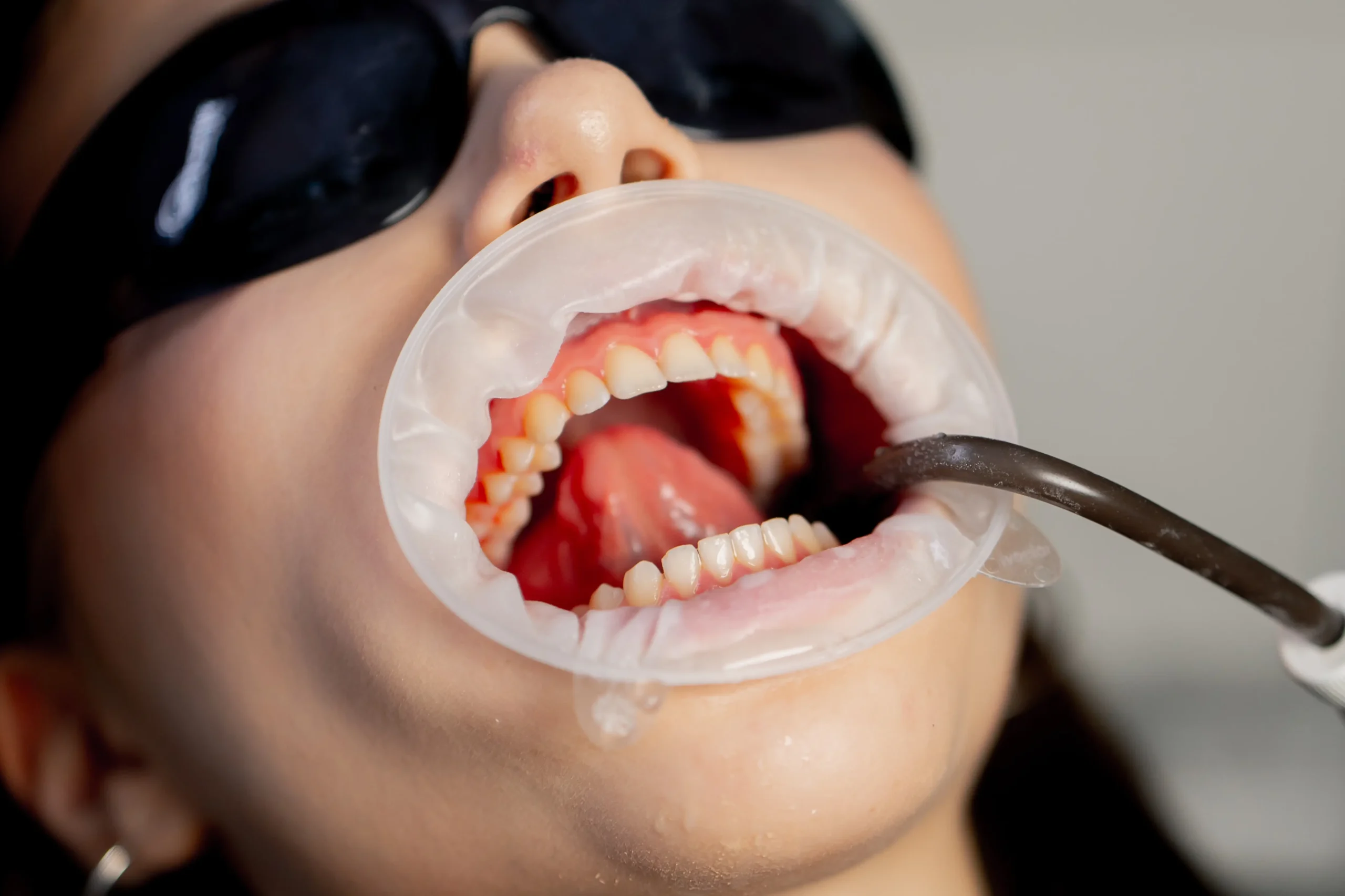 Can Gingivitis Be Reversed?
