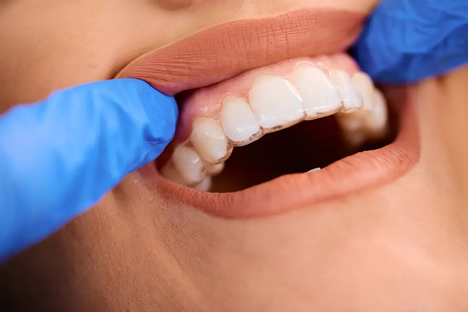Invisalign or Braces: Which One Straightens Teeth Faster?