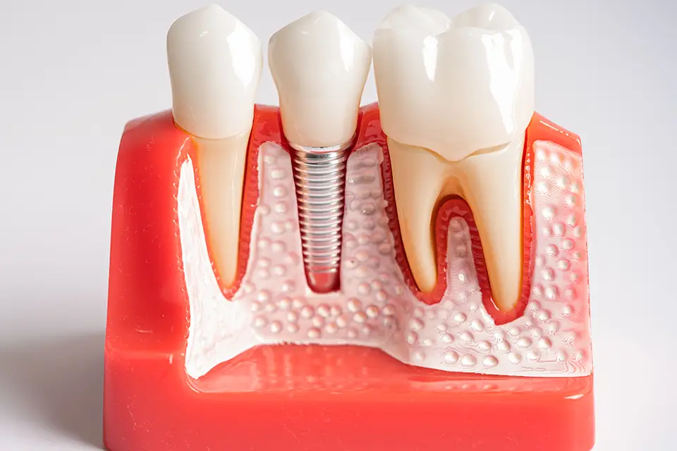 Do Dental Implants Hurt? What to Expect Before and After Surgery