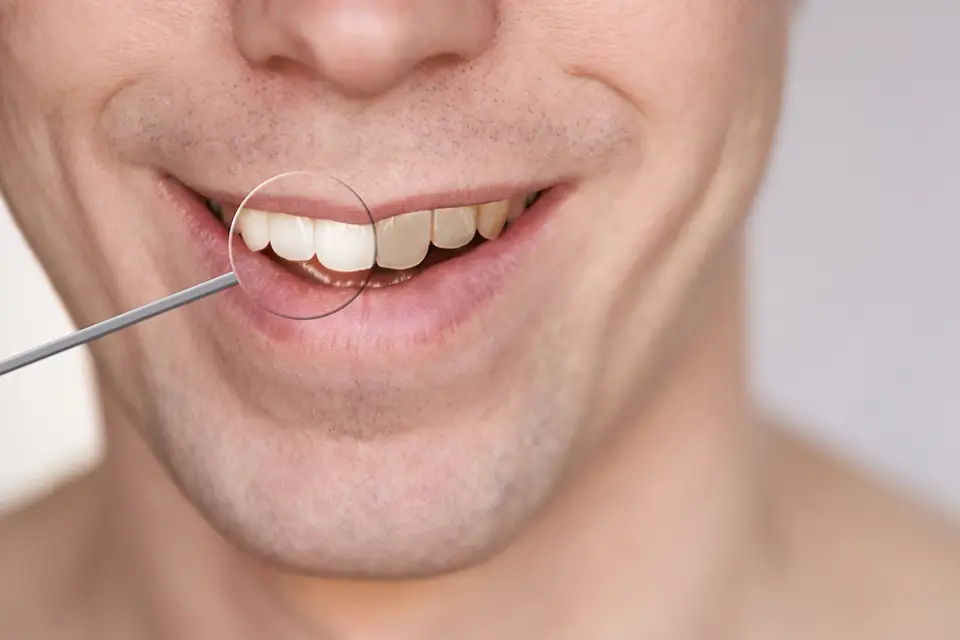 "Why Do I Have One Dark Tooth?" Common Causes & Treatment Options