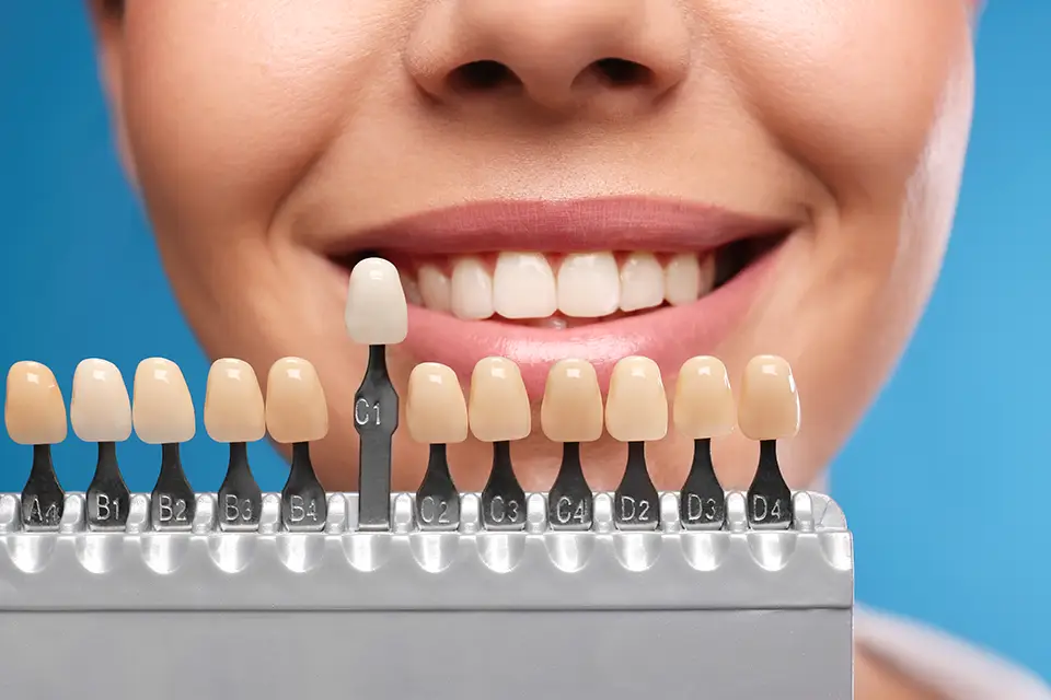 What Are Veneers? How Dental Veneers Work and Who They're Best For