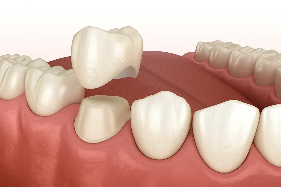 Dental Crowns Sunshine Dentistry Richmond Hill, Ontario