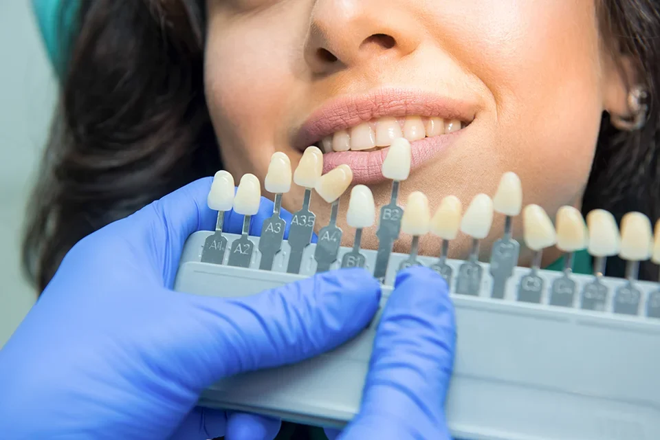 What are Dental Crowns?
