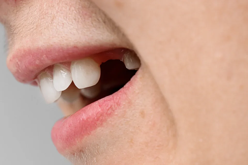 Why Do You Need Dental Extractions?