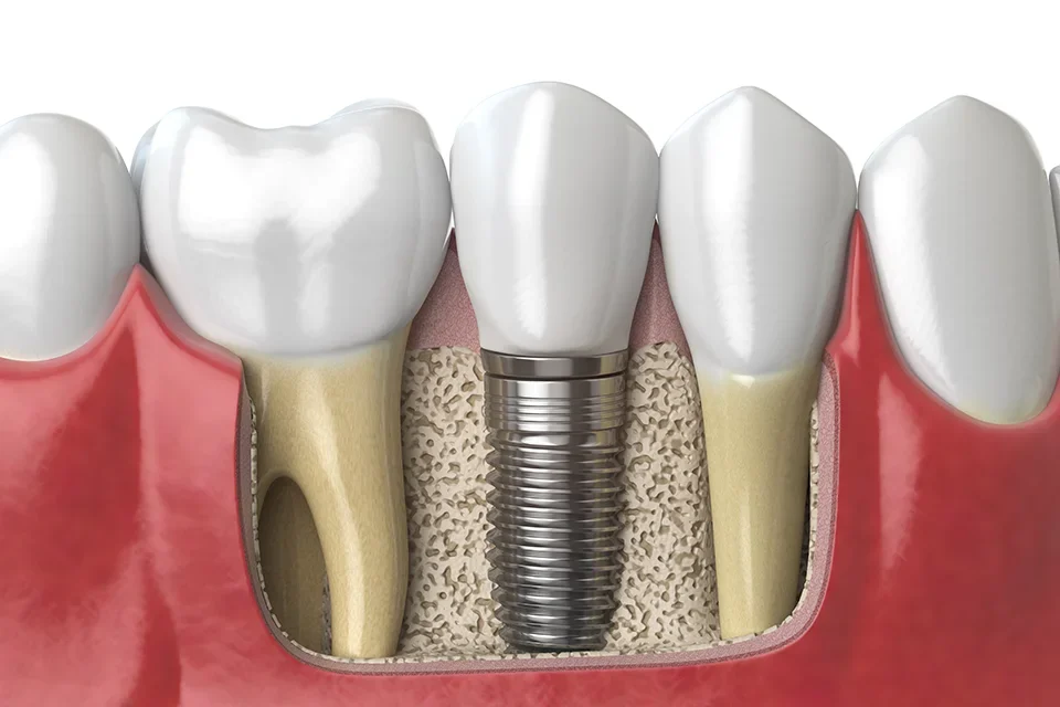 Dental Implants Sunshine Dentistry Richmond Hill, Ontario