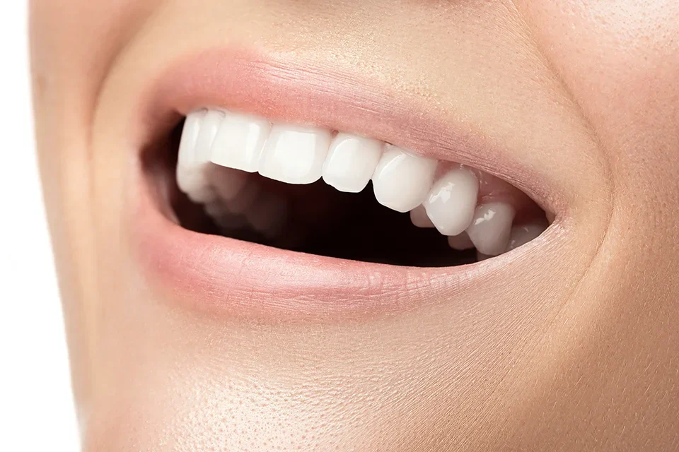 Dental Veneers What Are Dental Veneers?