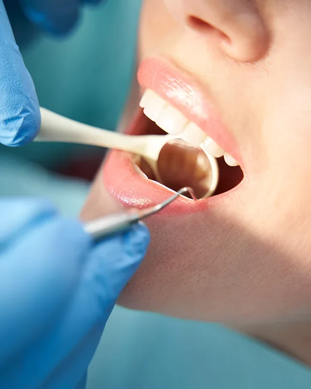 Emergency Dentistry A woman in a dentist chair with her mouth open, undergoing dental treatment during a dental crisis