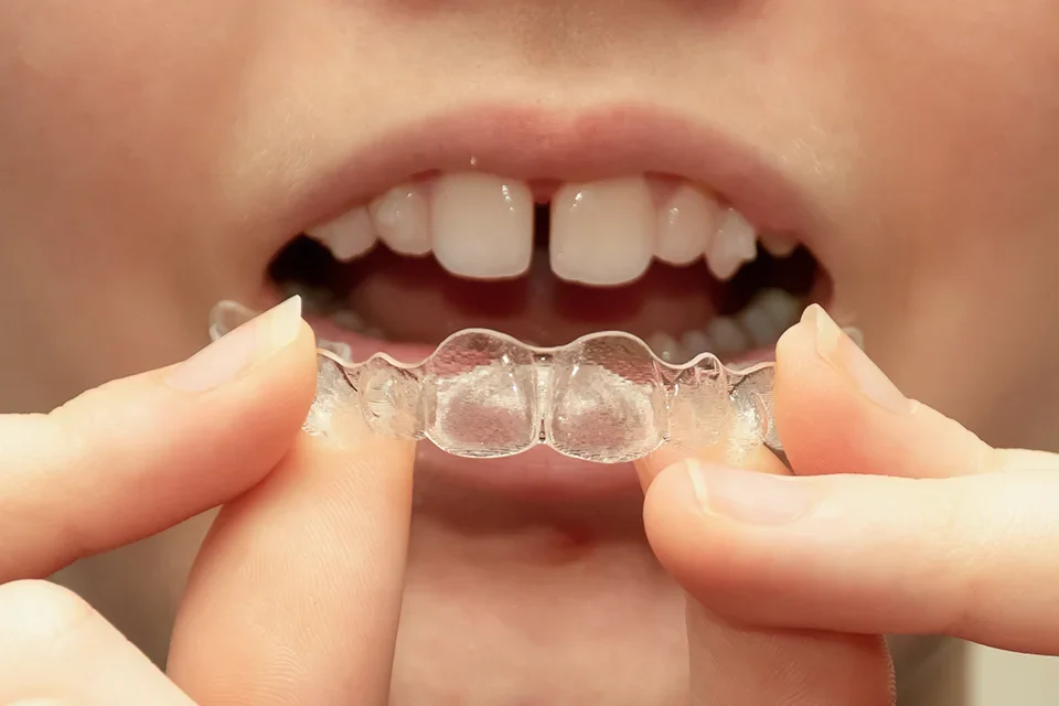 Invisalign