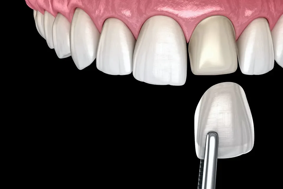 Can You Get a Root Canal on Front Tooth with a Veneer?