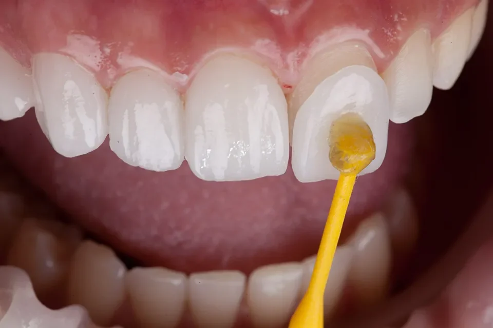 The Process of Getting Veneers to Close Gap in Front Teeth