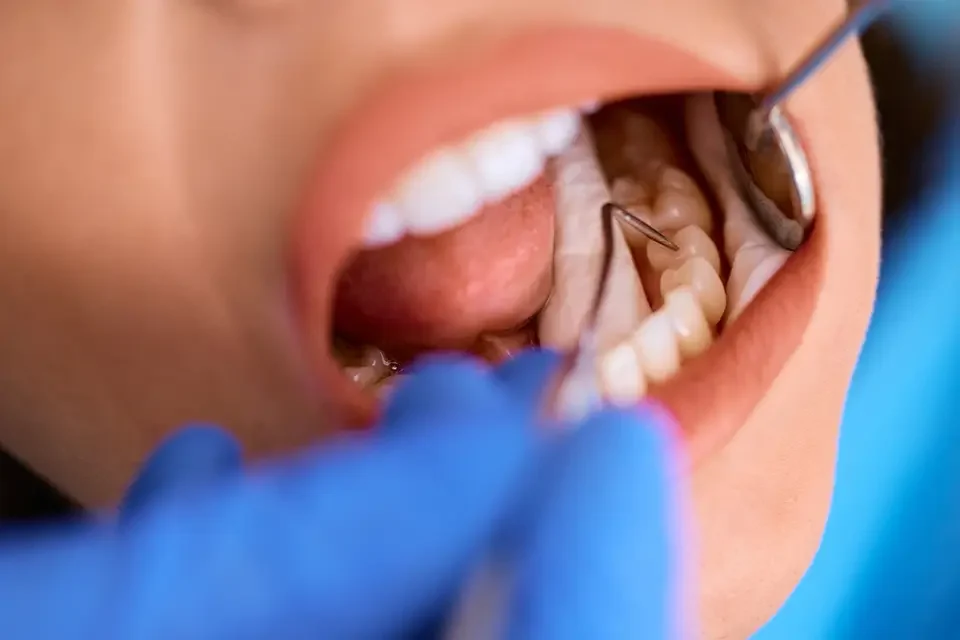 close-up-of-woman-during-teeth-check-up-at-dentist 4. Is Deep Teeth Cleaning Painful?