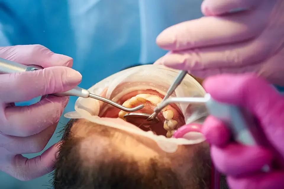 Treatment for Root Cavity