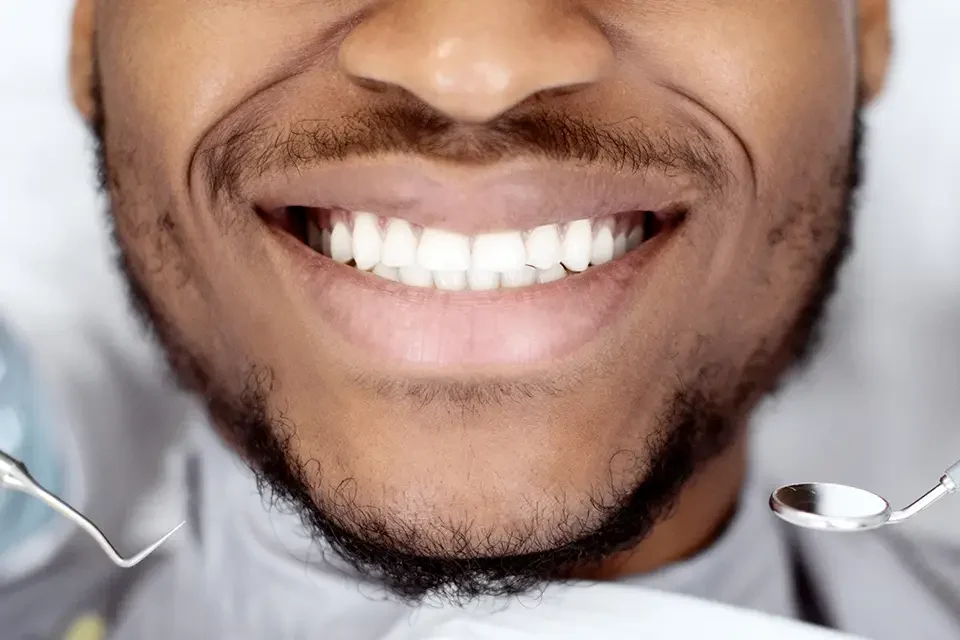 What Is Carbamide Peroxide Teeth Whitening?