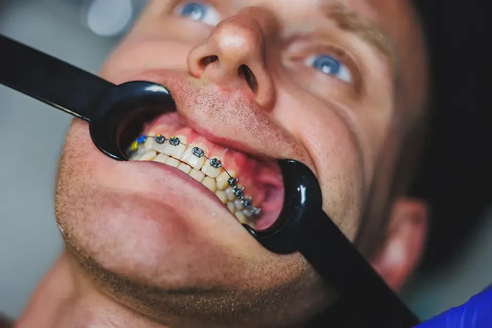 dental-treatment-of-teeth-a-young-man-at-a-dentist Invisalign or Braces: Typical Timelines You Can Expect