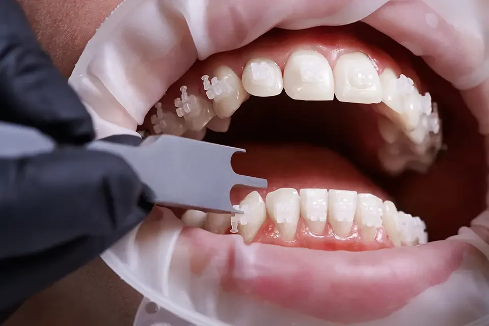 dentist-checking-height-of-bracket-placement The 5 Steps Involved in Prepping Teeth for Veneers