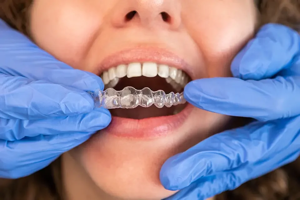 dentist-in-gloves-applying-invisible-aligner Biology Behind Movement: The Tissue Answer to "Why Does My Invisalign Hurt??"