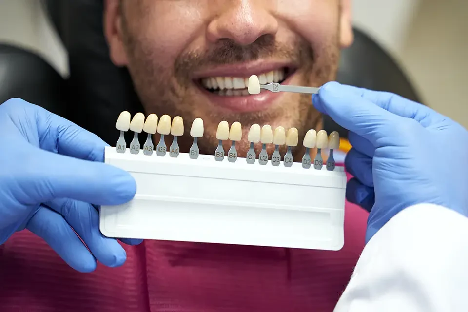 Benefits of Permanent Dental Veneers