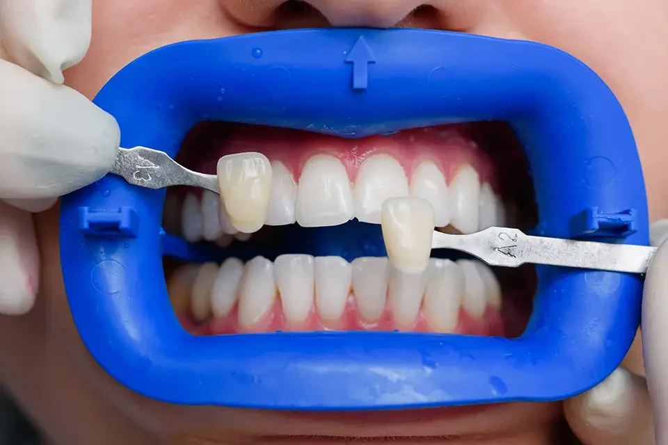 Carbamide Peroxide Teeth Whitening: How Long Do Results Last?
