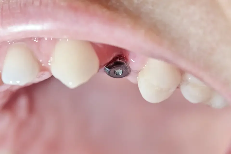 real-mouth-with-dental-molar-screw-implant How Can You Replace a Missing Tooth: Begin with Health, Bone, and Bite