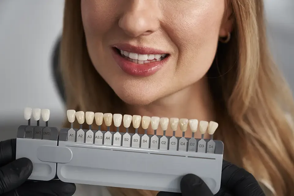Cost of Emax Veneers